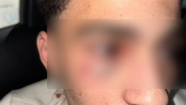 20-centimeter facial wounds: Medical report released for young man attacked with bladed weapons in Banha.