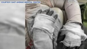 The Department of Health (DOH) said Friday the number of fireworks-related injuries, which stood at over 200 as of early New Year's morning, could still increase as data are still being validated.