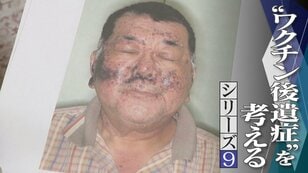 Moretones de color rojo oscuro por toda la cara... Manos y pies también hinchados El marido desarrolla una enfermedad incurable y muere tras la vacuna contra la COVID-19 "Si no se investiga, es una muerte en vano" [Serie 'Reflexionando sobre los efectos secundarios de las vacunas' 9]