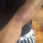 押し入った男らに殴られて腫れ上がった男性の腕＝９日、鎌倉市鎌倉山２丁目