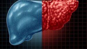 صحة وطب الكبد الدهني ـ تعبيرية