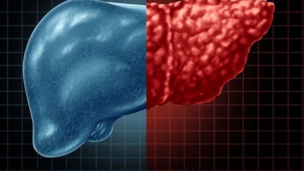 صحة وطب الكبد الدهني ـ تعبيرية