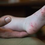 Hand, foot and mouth disease can cause painful mouth sores that blister and a rash, typically on the hands and feet